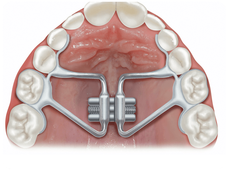 dr-andrea-mascanzoni-ortodonzia-espansori-del-palato-rev